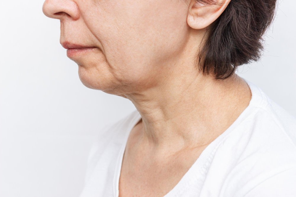 does weight loss cause jowls