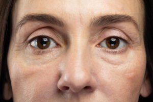how to get rid of eye bags