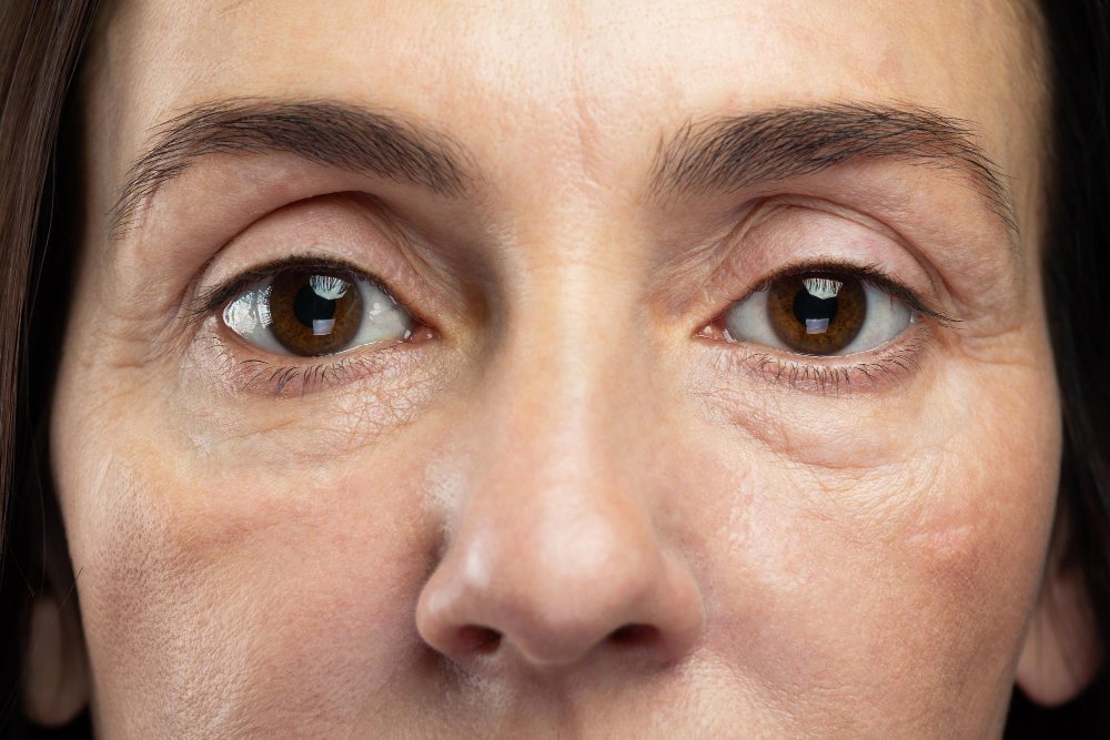 how to get rid of eye bags