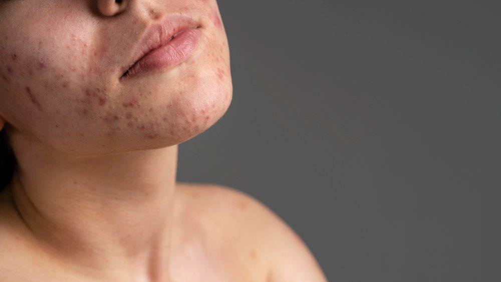 is it normal to worry about acne in your 30s and 40s