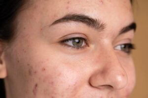 do acne scars get worse if left untreated