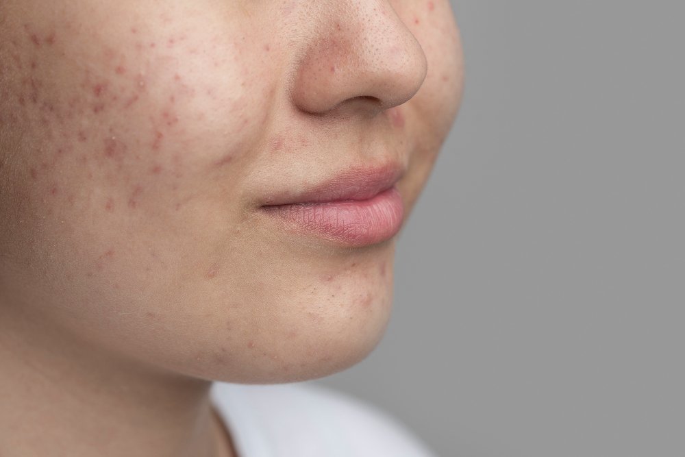 when should you do something about acne