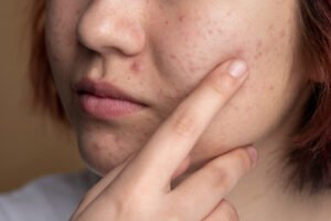 at what age does acne usually start
