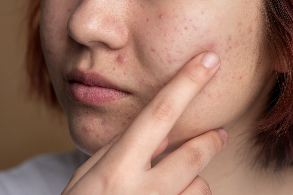 at what age does acne usually start