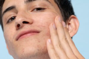 at what age does acne scars usually start