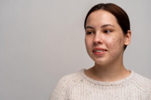 does picking spots cause acne scarring