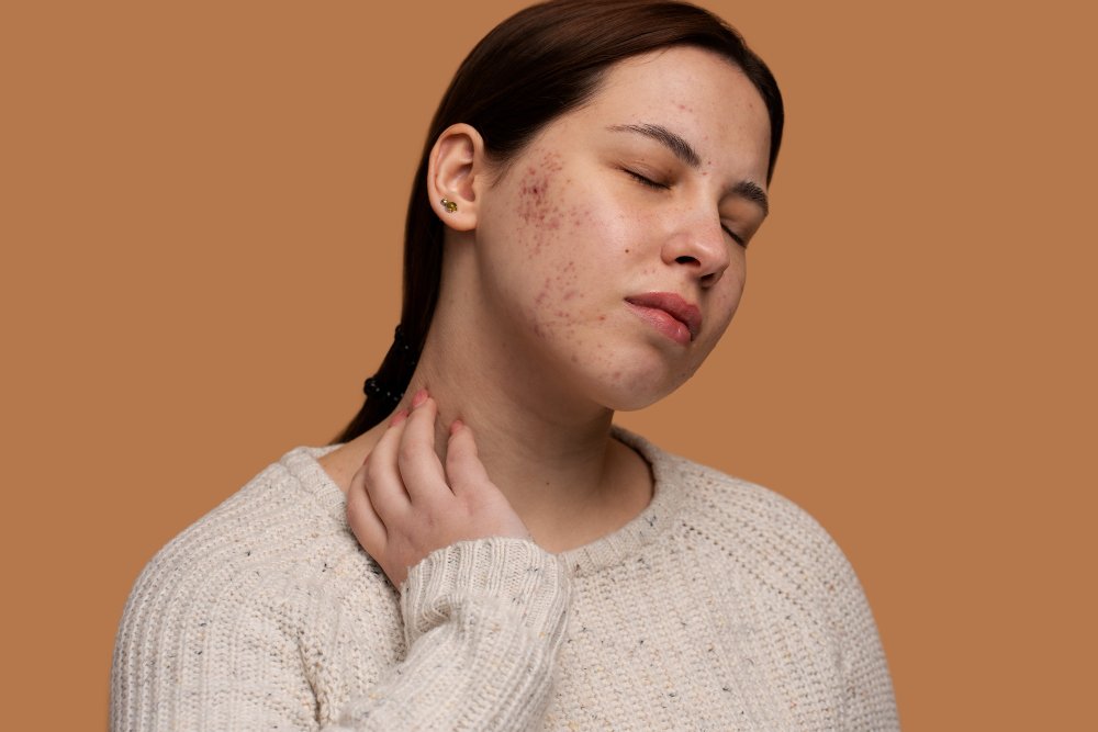 when should you do something about acne scars