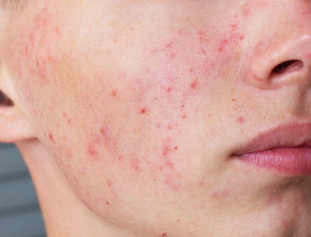 does acne get worse if left untreated