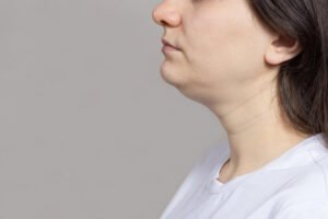 can a double chin be prevented