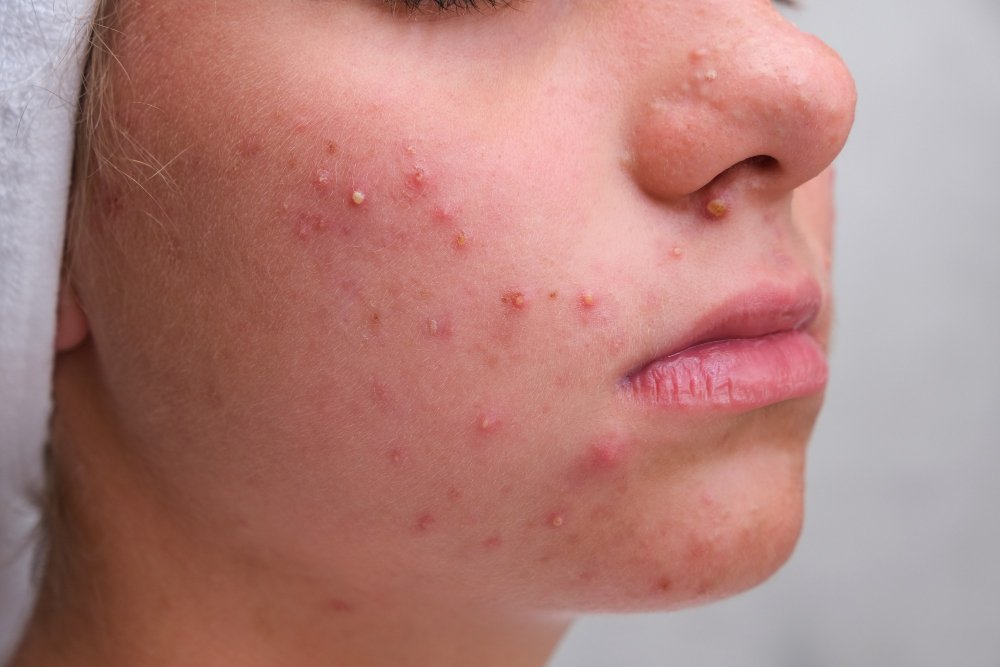 do hormones cause acne