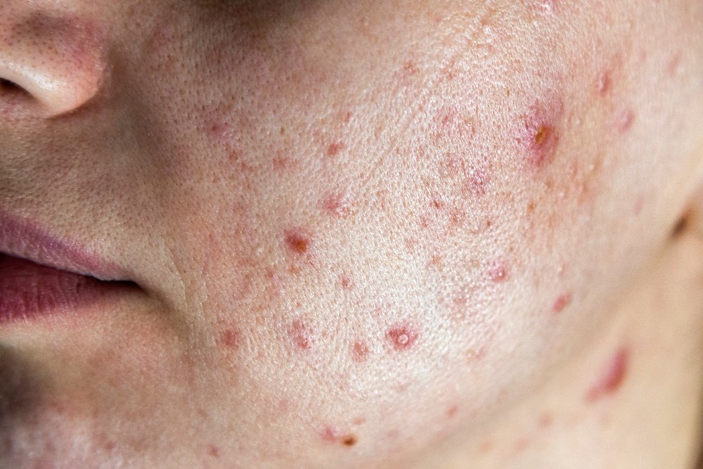 can acne be prevented