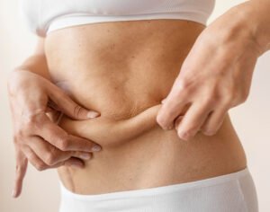 does weight loss cause loose skin
