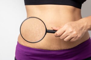 do stretch marks decrease skin elasticity