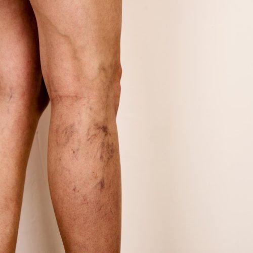 varicose veins