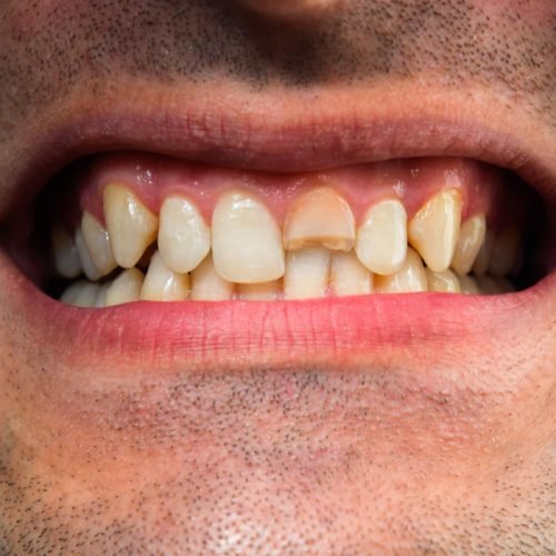 damaged teeth