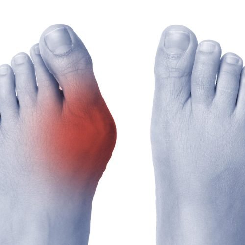 bunions