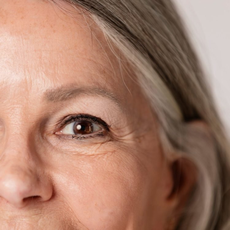can crow's feet be prevented