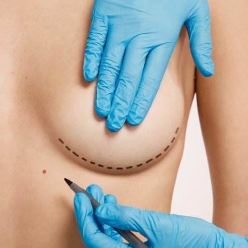 post-mastectomy