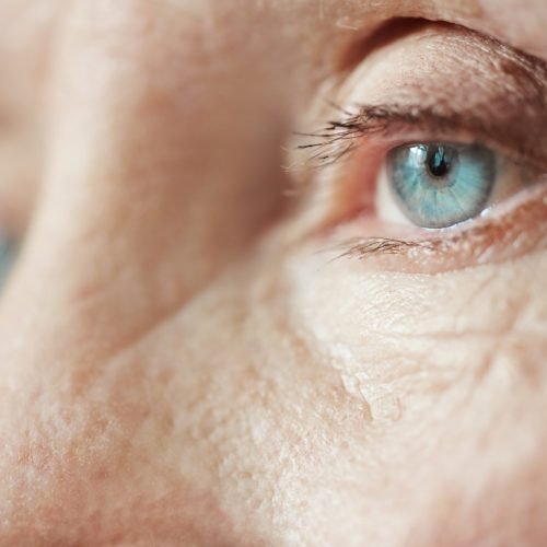 cataracts