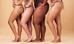do hormones cause lipoedema