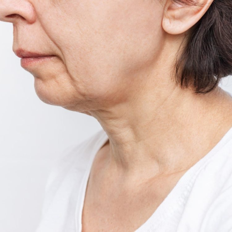 does weight loss cause jowls