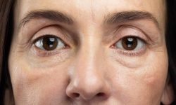 how to get rid of eye bags