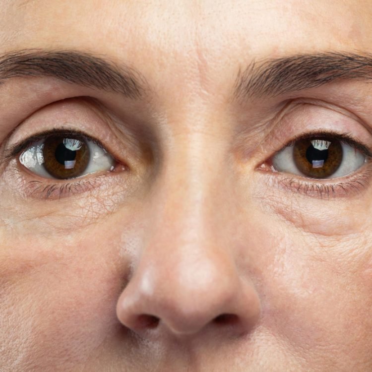 how to get rid of eye bags