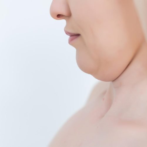 double chin