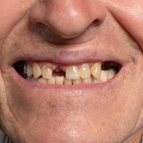 missing teeth