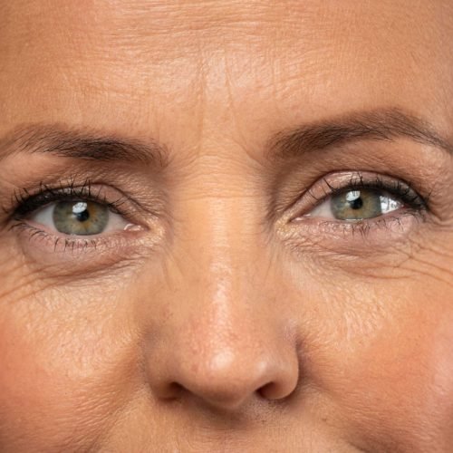 crows feet
