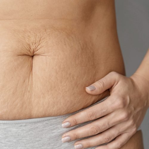 stretch marks