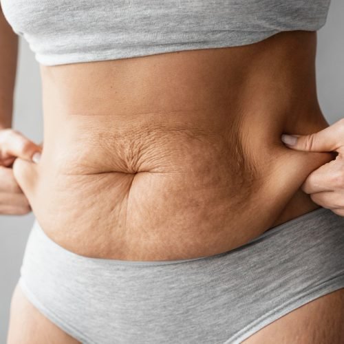 loose skin