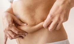 does weight loss cause loose skin