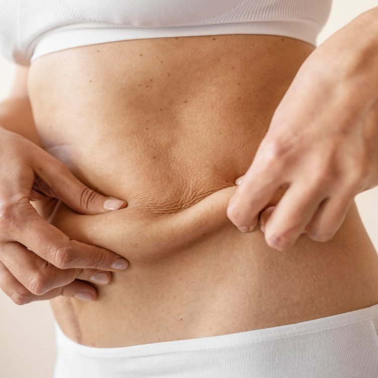 does weight loss cause loose skin