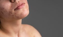 can acne scarring be prevented