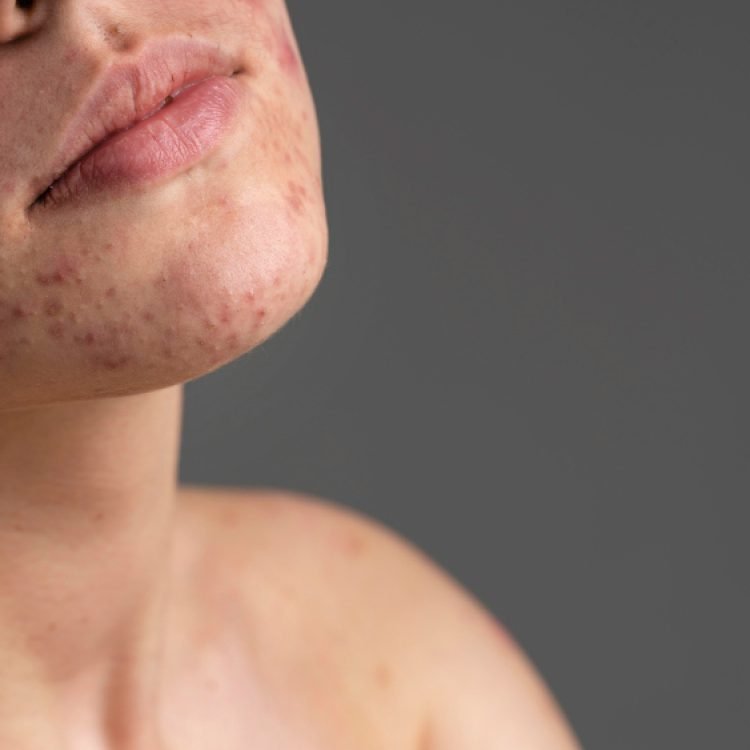 is it normal to worry about acne in your 30s and 40s