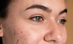 do acne scars get worse if left untreated