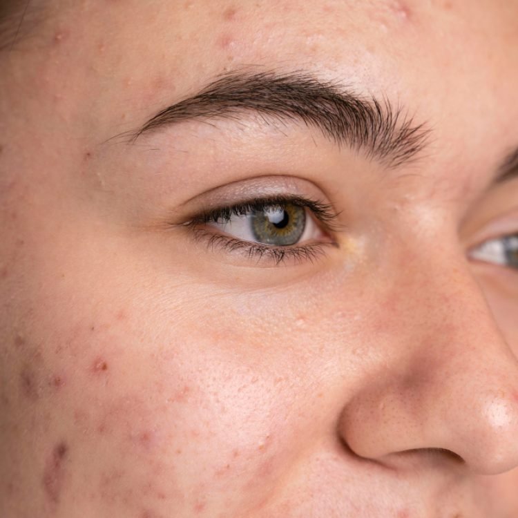 do acne scars get worse if left untreated