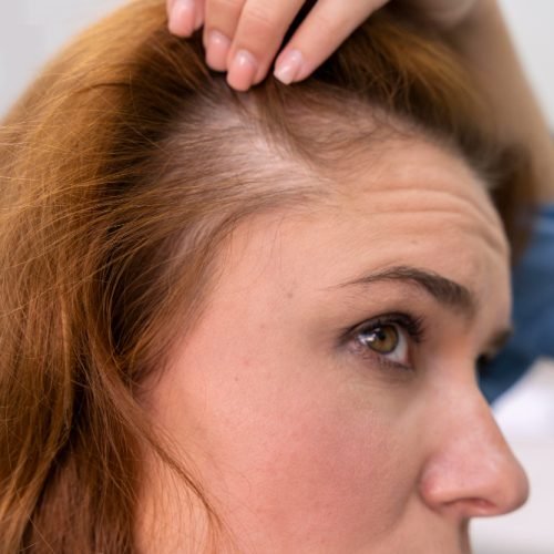 female hair thinning