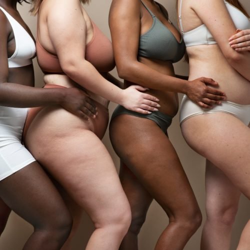 lipoedema