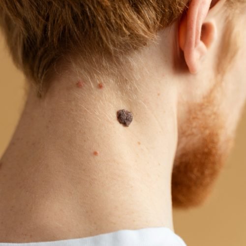moles