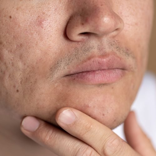 acne scars