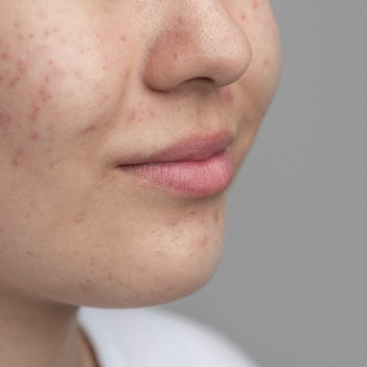 when should you do something about acne