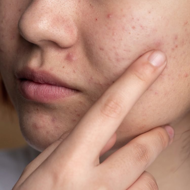 at what age does acne usually start