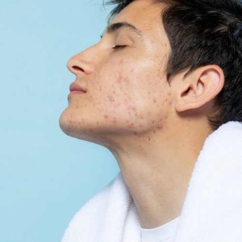 acne