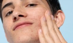 at what age does acne scars usually start