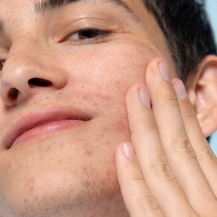 at what age does acne scars usually start