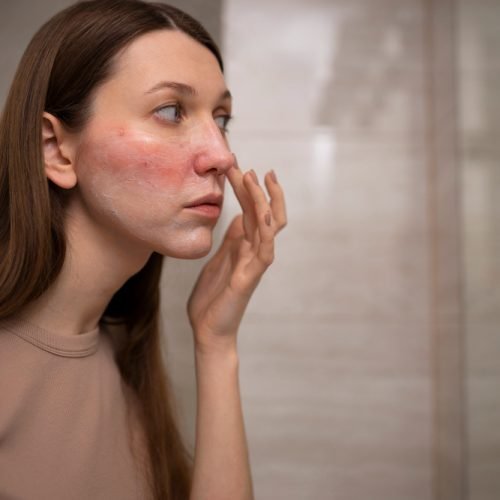 rosacea