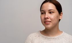 does picking spots cause acne scarring