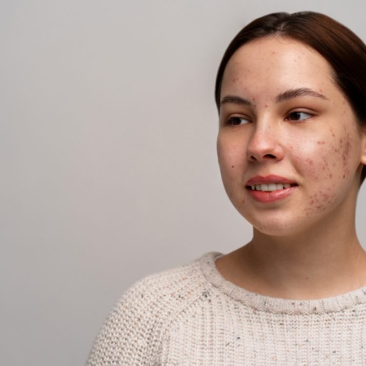 does picking spots cause acne scarring